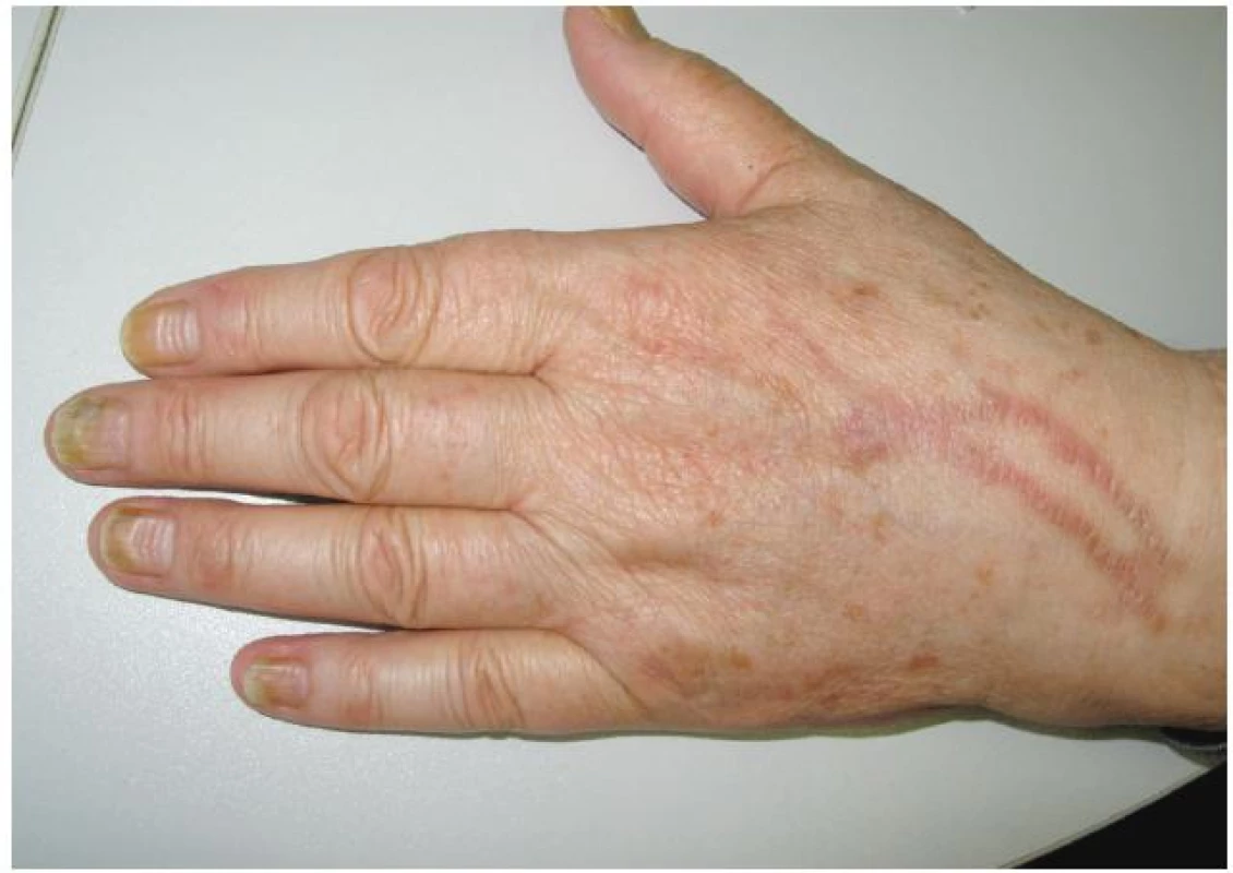 Série Beauových linií po opakovaných cyklech i. v. chemoterapie
Na hřbetě ruky postflebitické hyperpigmentace po infuzích.