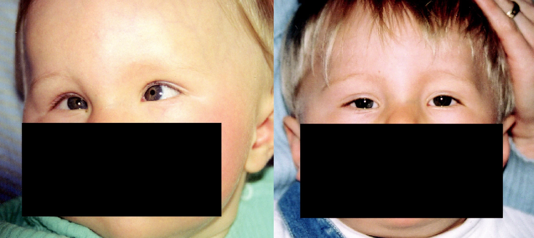 Oboustranná vrozená paréza n.VI. v primárním postavení očí před a 1,5 roku po transpoziční operaci
