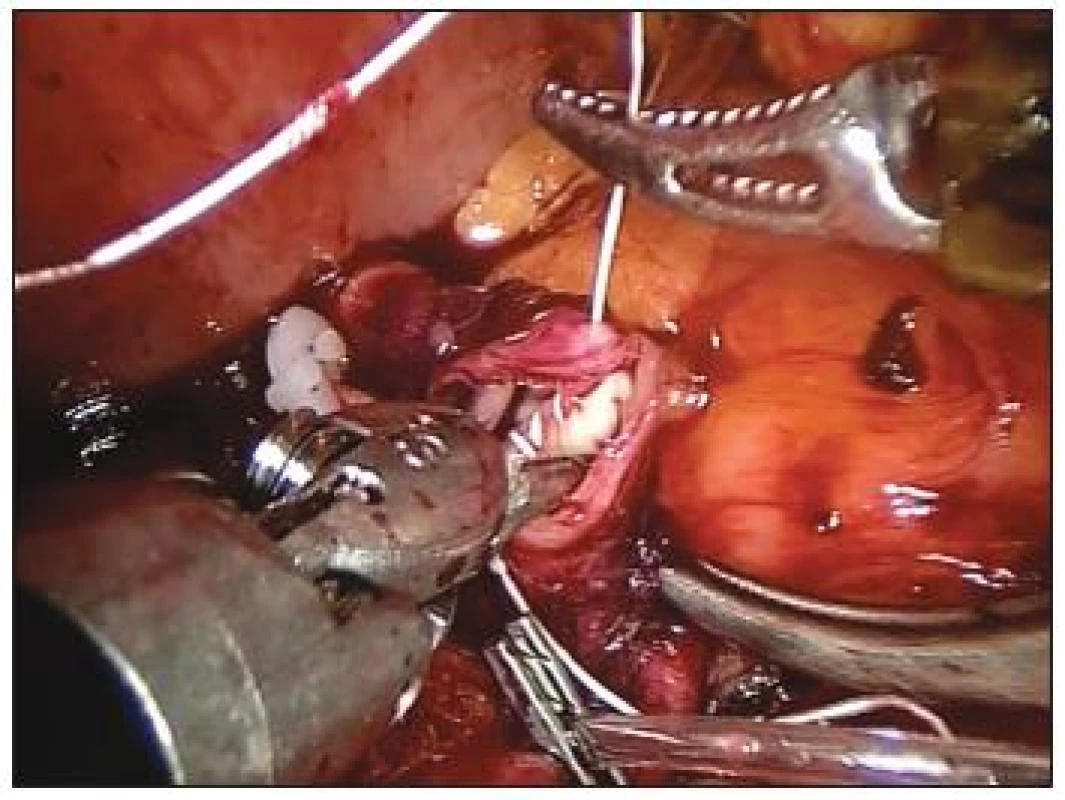 Přímá end to end anastomóza slezinné tepny po exkluzi její výdutě
Fig. 7. Direct, end to end anastomosis of the splenic artery, following exclusion of the aneurysm