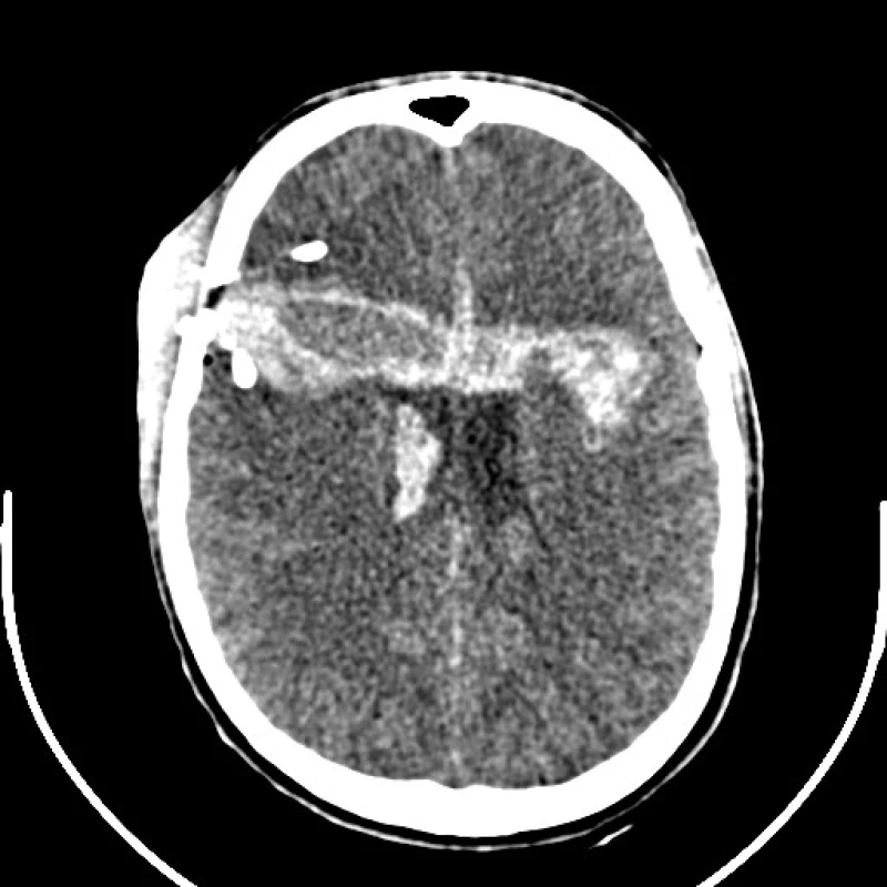 Poúrazové CT nativně: vstřel v pravé frontální krajině s úlomky kostní tkáně, cizí těleso v levém frontálním laloku v hematomu špatně rozlišitelné