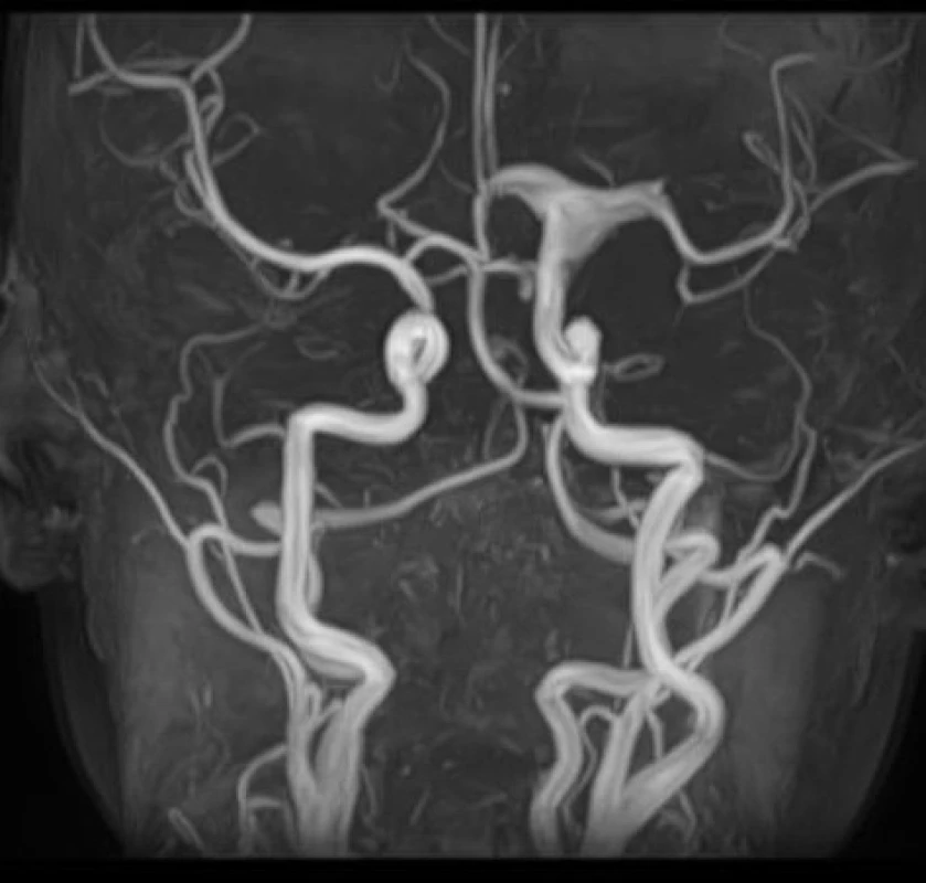 MRI AG s nálezem aneurysmatické dilatace intrakraniální části ACI přestupující vlevo na ACA a ACM
