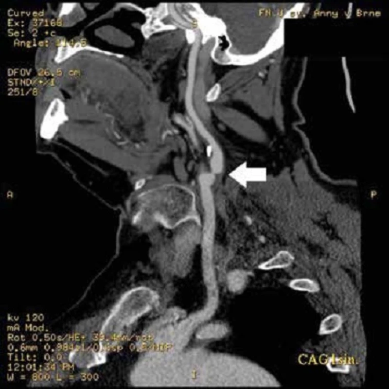 CT angiografické vyšetření zobrazující těsnou odstupovou stenózu (šipka) a. carotis interna vlevo (vessel analysis)
