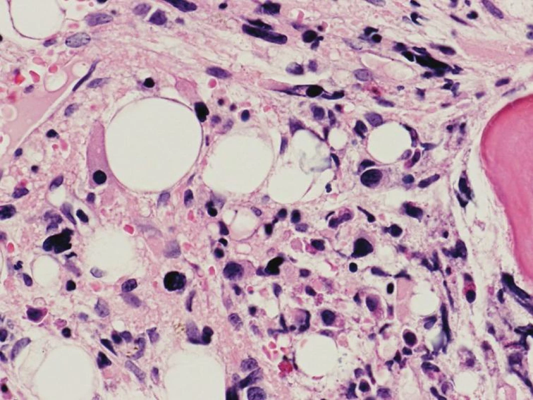 Fibrotické štádium PMF – rozvinutá kolagénová fibróza (eozinofilné hmoty) a malé MGK s bizardnými a výrazne denznými jadrami tvoriace tesné zhluky (hematoxylín-eozín 400x).