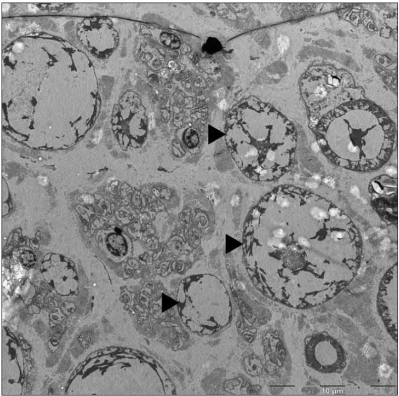 Mikrofotografie – skupina edematózně zduřelých axonů (►) s atrofickými až vymizelými myelinovými pochvami (elektronová mikroskopie, n. suralis).