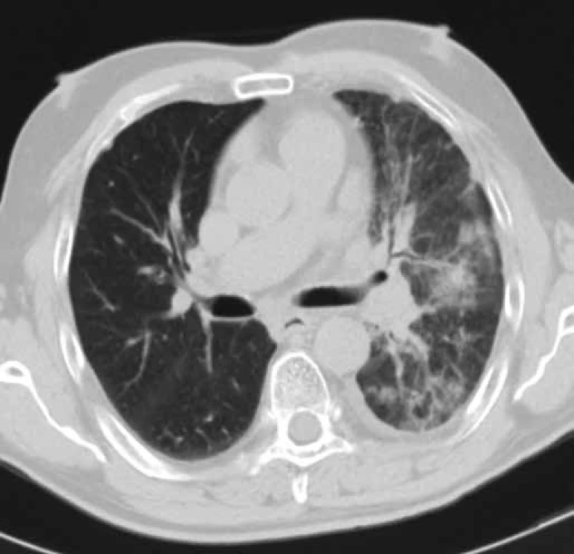 CT hrudníku pacienta č. 2 v době zahájení léčby erlotinibem (leden 2010).
Obrázek znázorňuje tumor dolního laloku levé plíce cirkulárně zužující průsvit dolního lobárního bronchu a související dys-/atelektatické změny dolního laloku levé plíce