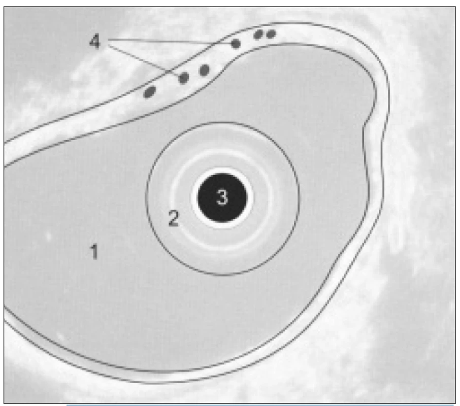 Schéma EUS obrazu žaludku: 1. lumen žaludku, 2. balonek endosonografu, 3. endosonografická sonda, 4. intramurální varixy.