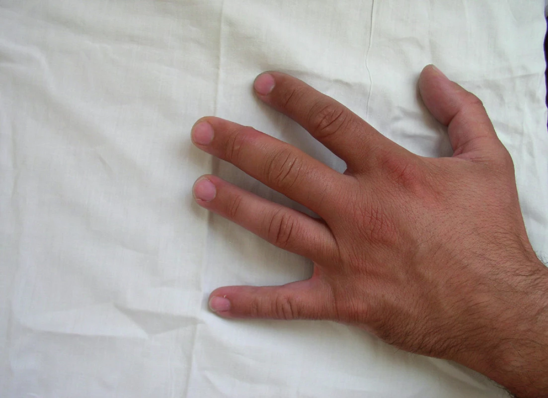 Erytematozní otok a vesikula na III. prstu levé ruky po poranění ostnatcem (archív KICH FN Brno)