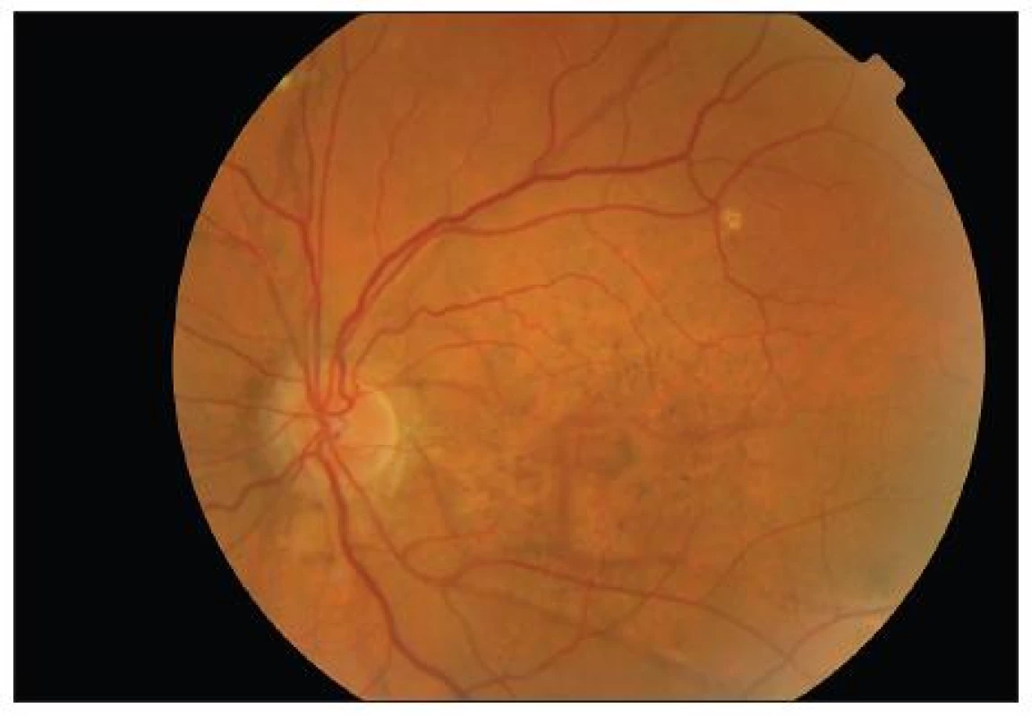 Očné pozadie ľavého oka. Peripapilárna atrofia chorioidey a atrofia pigmentového epitelu sietnice v celej makulárnej krajine s presvitaním hnedastých angioidných prúžkov