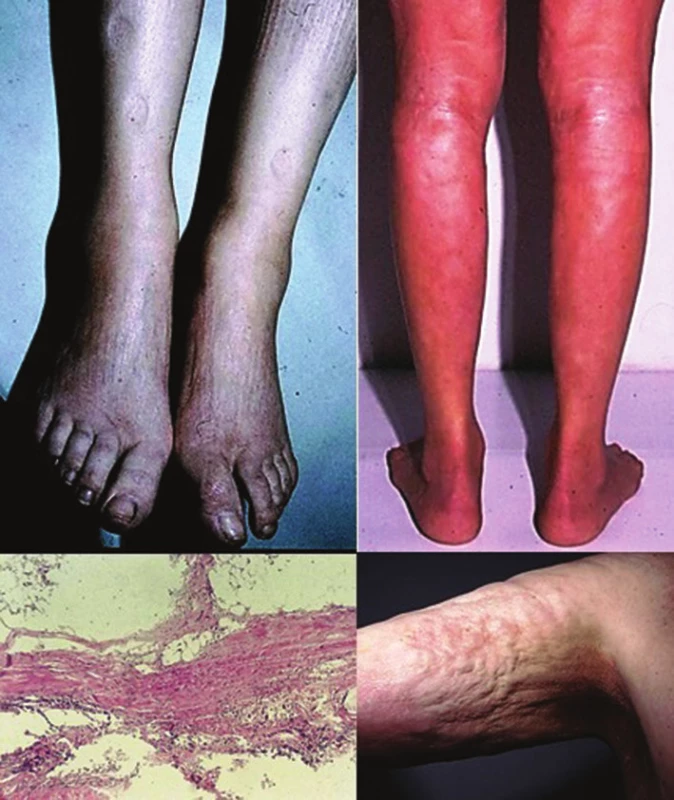 Eozinofilní fasciitida – „dolíčkování“ kožního povrchu