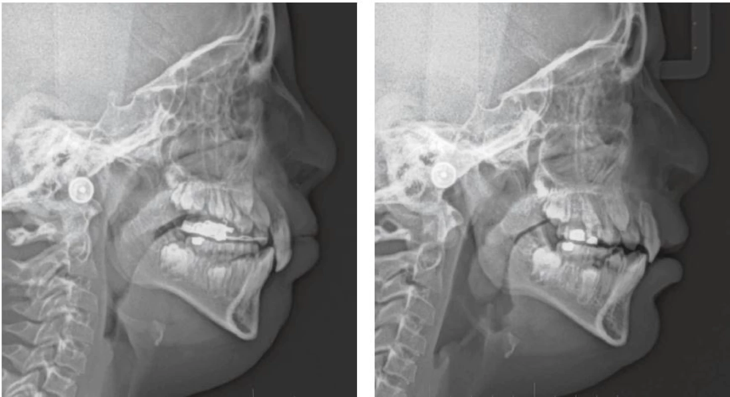 A, B. Lateral cephalometric radiograph before (A) and six months after (B) the surgical repositioning of premaxilla in the day of fixed appliance removal