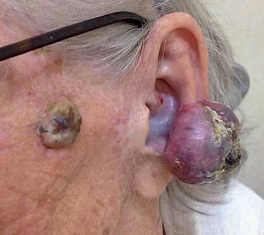 A solitary erythematous nodule with hyperkeratotic and ulcerated surface on the left ear lobe (front view).