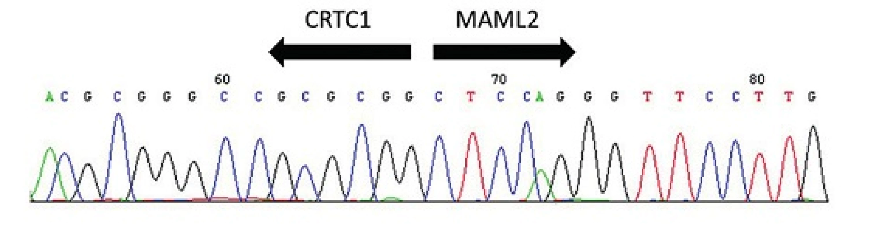 Sekvenogram fúzního transkriptu &lt;i&gt;CRTC1-MAML2&lt;/i&gt;. Šipky vyznačují místo fúze.