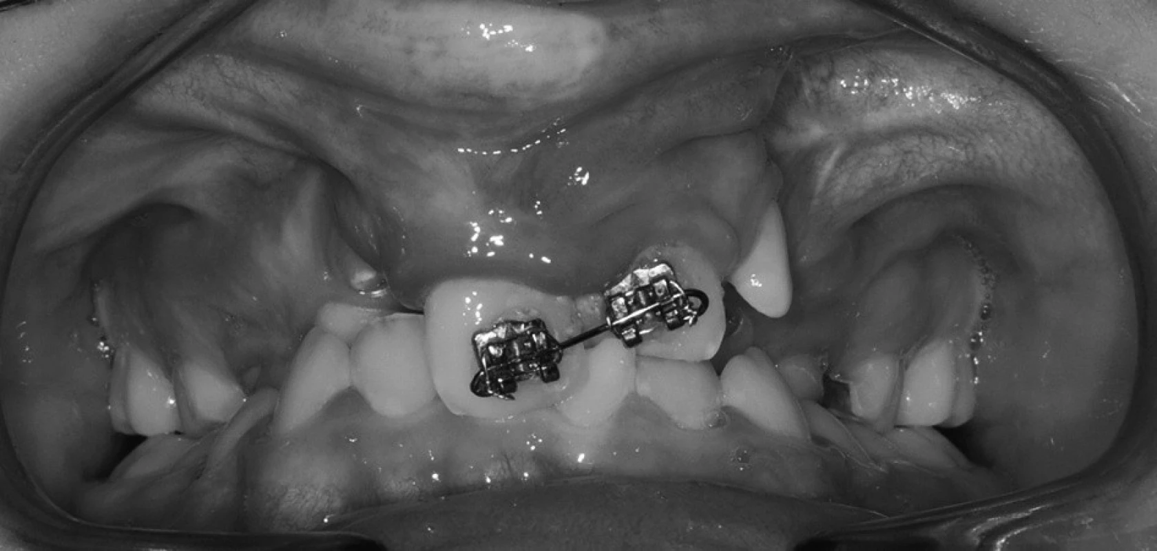 Smíšený chrup pacienta s oboustranným celkovým rozštěpem, zub 21 prořezal do zákusu, na zubech 11 a 21 je nasazen parciální fixní aparát.