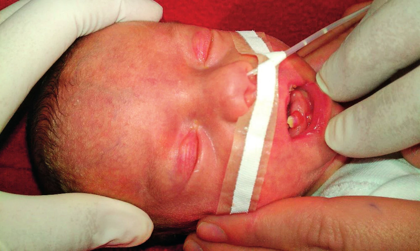 Předčasně narozené dítě s prořezaným dolním řezákem