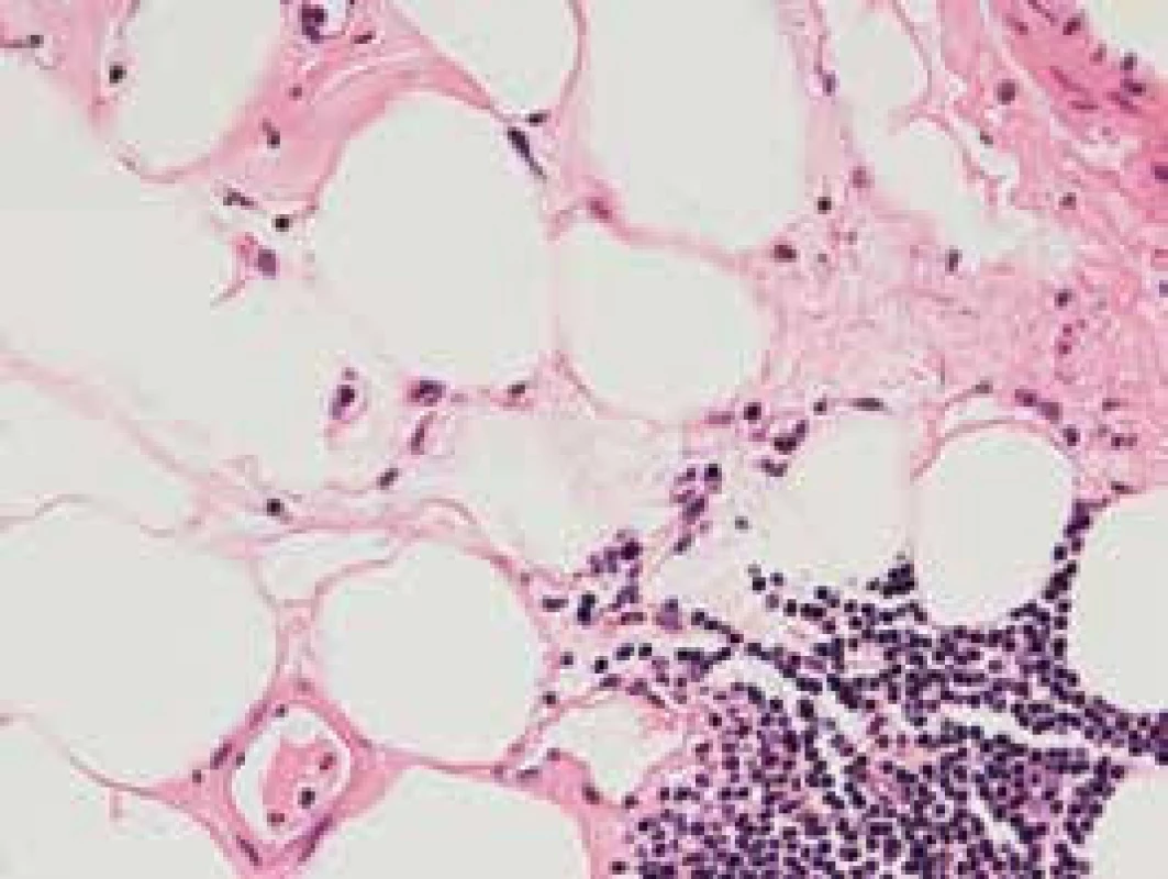 Fokálna akumulácia malých lymfocytov
v interstíciu – HE farbenie