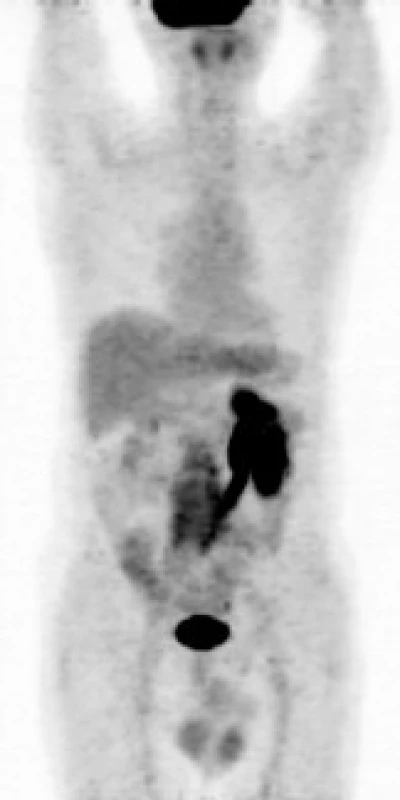&lt;sup&gt;18&lt;/sup&gt;F- FDG PET – MIP (maximum intesity projections) v barevné škále grayscale: ložisko patologického hypermetabolizmu glukózy (akumulace radiofarmaka &lt;sup&gt;18&lt;/sup&gt;F- FDG) v retroperitoneu obkružující kaudální část břišní aorty a společné ilické tepny. Je patrné městnání aktivní moči při vylučování radiofarmaka v levé ledvině a levém ureteru.
