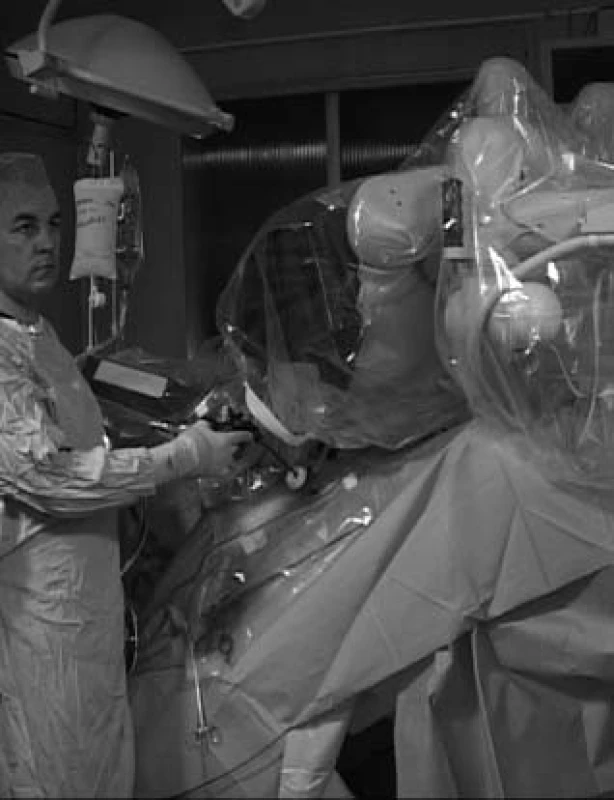 Robot v poloze nad pacientem; operatér na straně pacienta užívá běžné laparoskopické nástroje. Pacient je ve strmé poloze hlavou dolů.