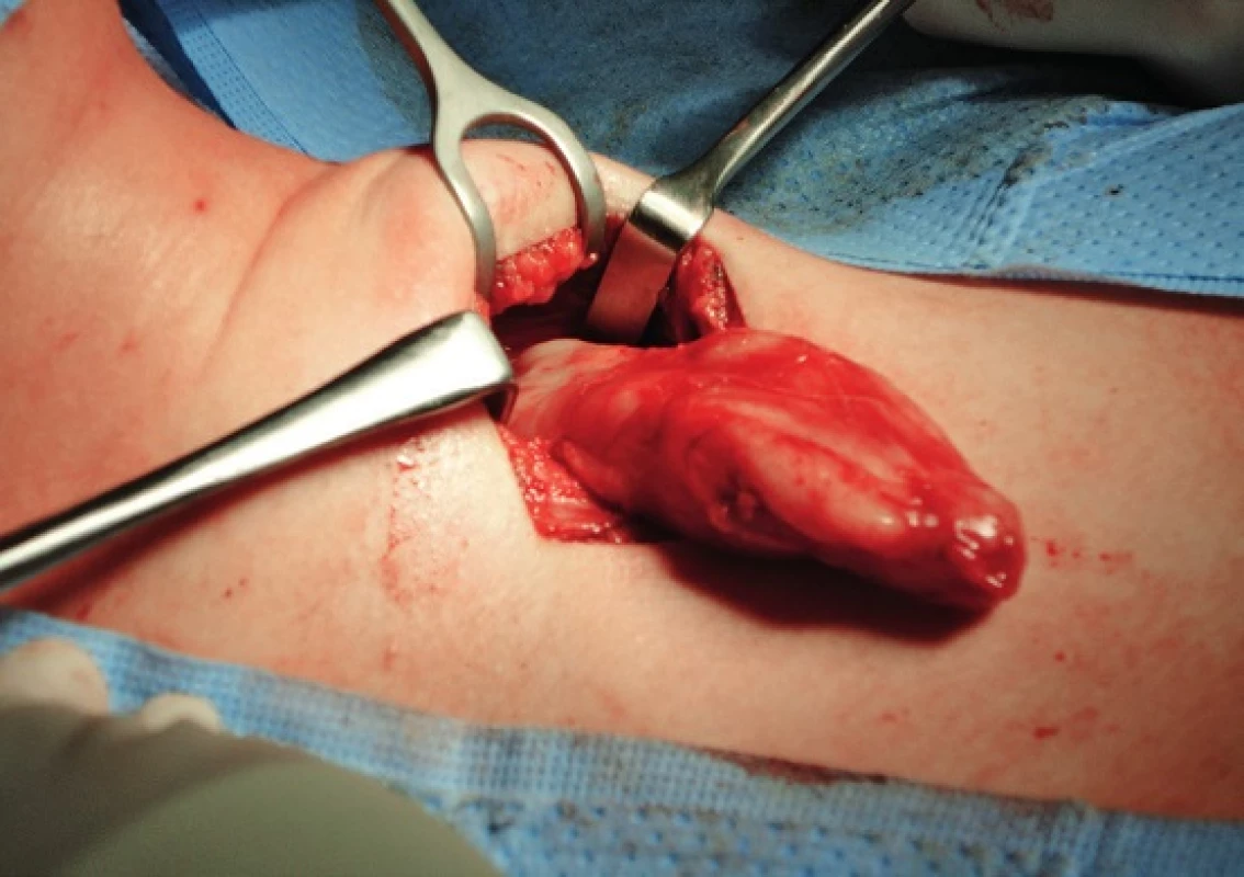 Chirurgické odstranění tumoru z límcového řezu.