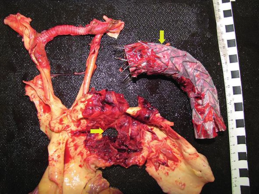 Rozstrihnutý oblúk aorty s defektom aortálnej steny (vodorovná šípka) a vyňatým aortálnym stentgraftom (zvislá šípka).