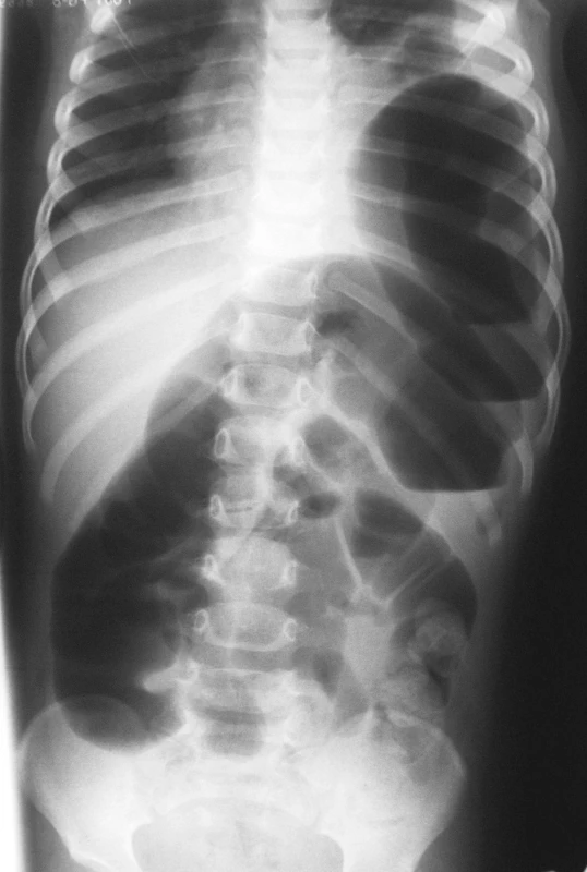 RTG hrudníka a brucha s ľavostrannou diafragmatickou herniou a ileóznym stavom
Fig. 4. Chest and abdominal x-ray views with a left-sided diaphragmatic hernia and ileus