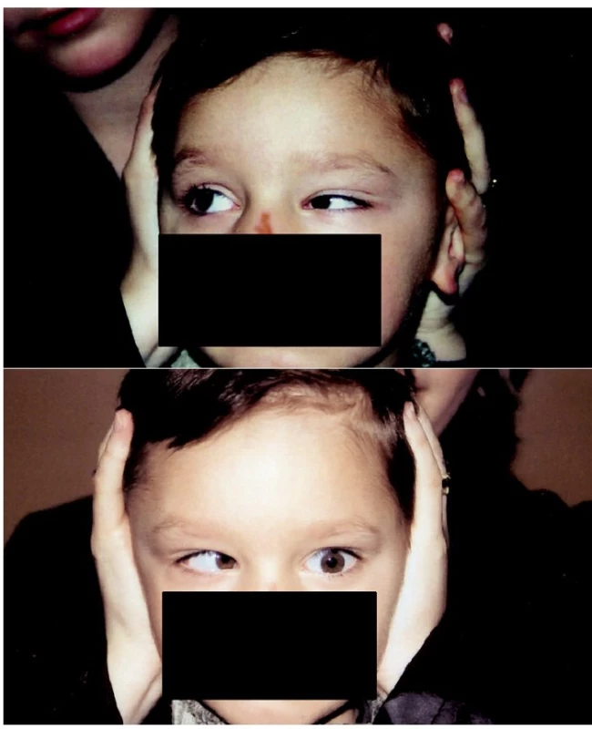 Duanův retrakční syndrom I levého oka, a – retrakce bulbu a zúžení oční štěrbiny, b – výrazně omezená abdukce