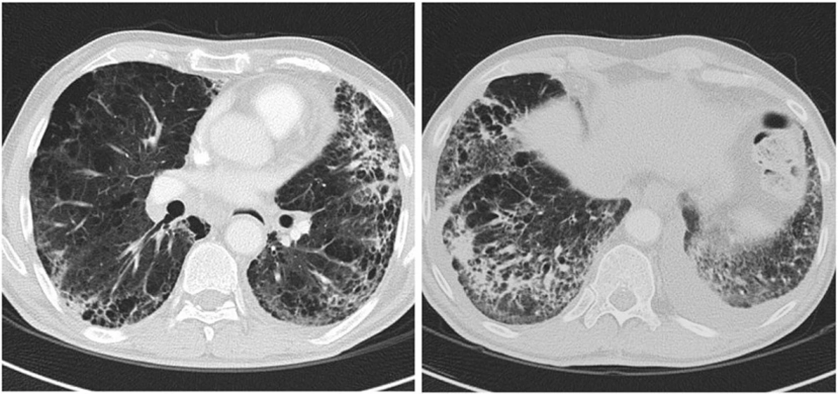 Chest CT scan image obtained at the time of clinical presentation with respiratory symptoms reveals nonspecific diffuse alveolar involvement