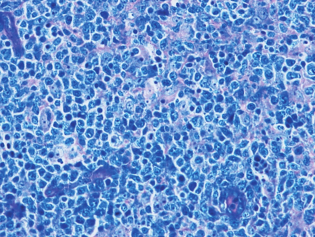 Vzorek z 2. bioptického odběru – DLBCL 
Barvení podle Giemsy, difuzní lymfom z velkých buněk.