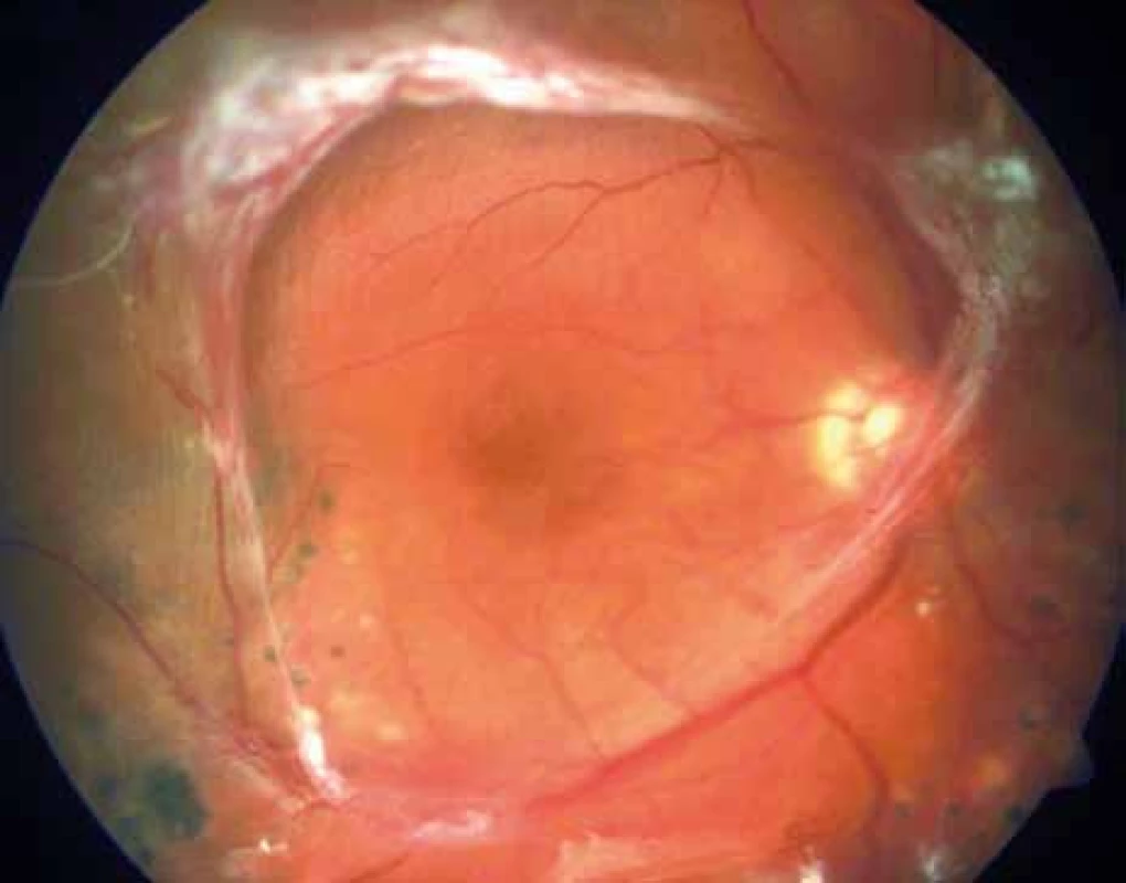 Pacient č. 2: Fundus oka pravého: proliferativní diabetická retinopatie s komplikacemi (trakčně-rhegmatogenním odchlípením a hemoftalmem) – mohutné fibroproliferace jdoucí podél temporálních cévních svazků, centrální krajina bez významných ložiskových diabetických změn.