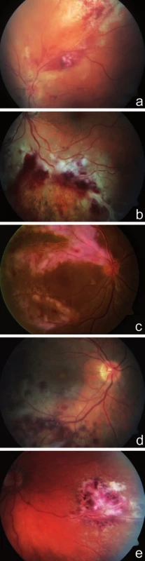 Fulminantní forma CMV retinitidy. Fotografie fundu dokumentuje nález bělavých ložisek retinální infiltrace a nekrózy s krvácením (obraz „kečupu a sýra“) u 59letého pacienta po transplantaci kostní dřeně pro lymfom a), u 32letého pacienta po alogenní transplantaci kmenových krvetvorných buněk pro akutní myeloidní leukémii b), u 51letého pacienta s non-Hodgkinovym lymfomem c), u 32letého pacienta po alogenní transplantaci kmenových krvetvorných buněk pro akutní myeloidní leukémii d), u 31letého pacienta po 2 transplantacích kostní dřeně pro akutní myeloidní leukémii e)