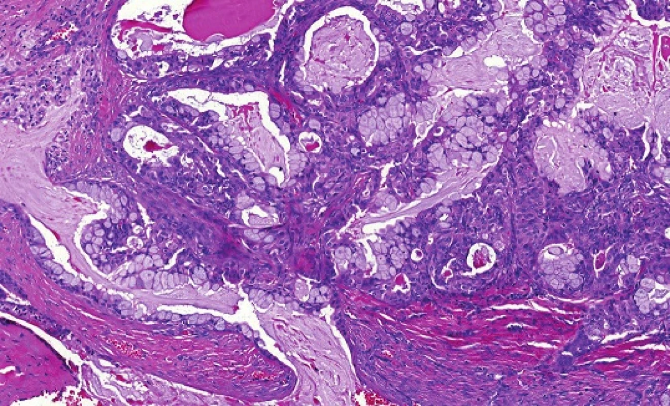 Mukoepidermoidní karcinom (low-grade) konvenční struktury sestávající ze tří typů nádorových buněk, mucinózních, epidermoidních a buněk intermediálního typu (hematoxylin-eozin).
