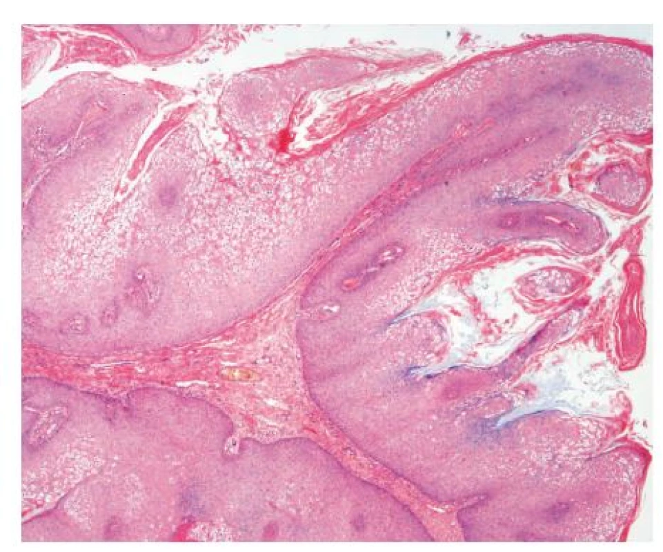 Histopatologický obraz lézie (HE, 25x). 
Mikroskopicky prítomné epitelové útvary s papilárnou stavbou, kryté hyperplastickým dlaždicovým epitelom s kompaktnou hyperkeratózou. Ložiskovo zachytené početné epitelové bunky vzhľadu koilocytov. Mitotická aktivita vo vzorke bola zvýšená. Cytologicky je proces benígnej povahy.