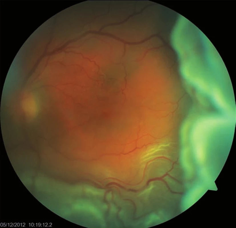 Foto očního pozadí před operací rhegmatogenní amoce (PPV bez provedení peelingu). Amoce je subtotální, zraková ostrost 2/50.