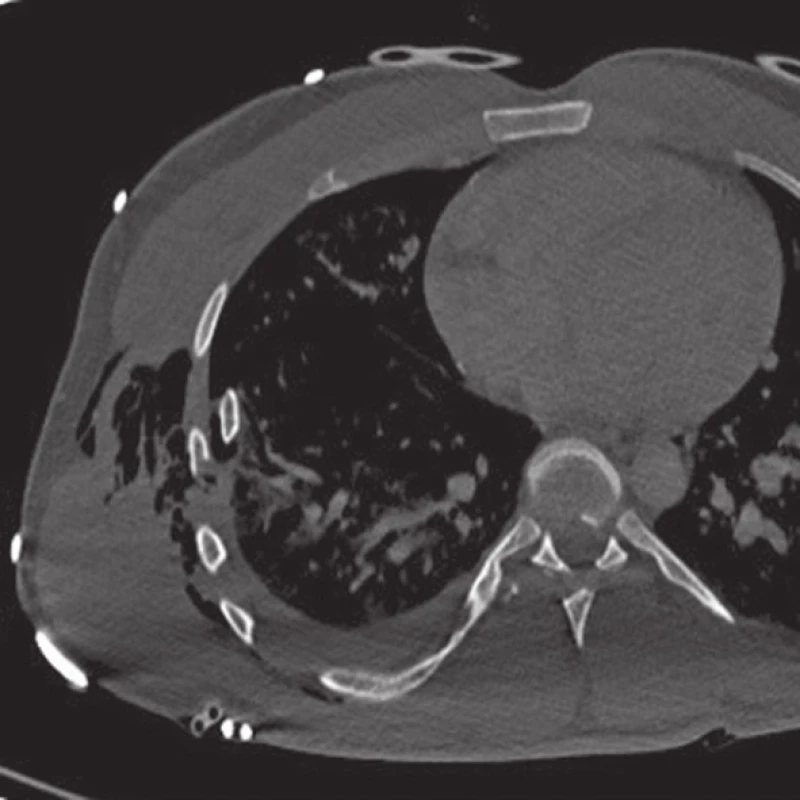Laterální typ, perforace plíce
Fig. 4: Lung perforation