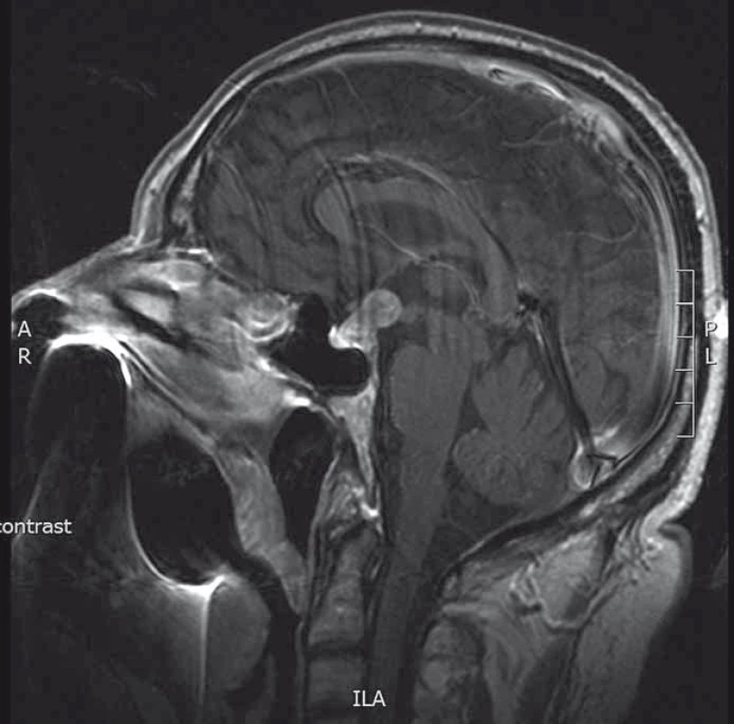 MRI hypofýzy (T1 vážené sagitální skeny s kontrastní látkou).
Patrná intra- a supraselární tumorózní expanze.