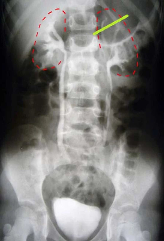 &lt;i&gt;Hemiureteronefrektómia horného segmentu obličky vľavo&lt;/i&gt;
Fig. 7. &lt;i&gt;Hemiureteronephrectomy of the upper segment of the left kidney&lt;/i&gt;