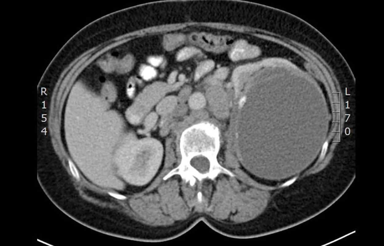 CT vyšetření: cystický útvar v horním pólu ledviny – kraniální část
Fig. 1. CT: axial section at the level of cystic formation in the upper pole of kidney – cranial part