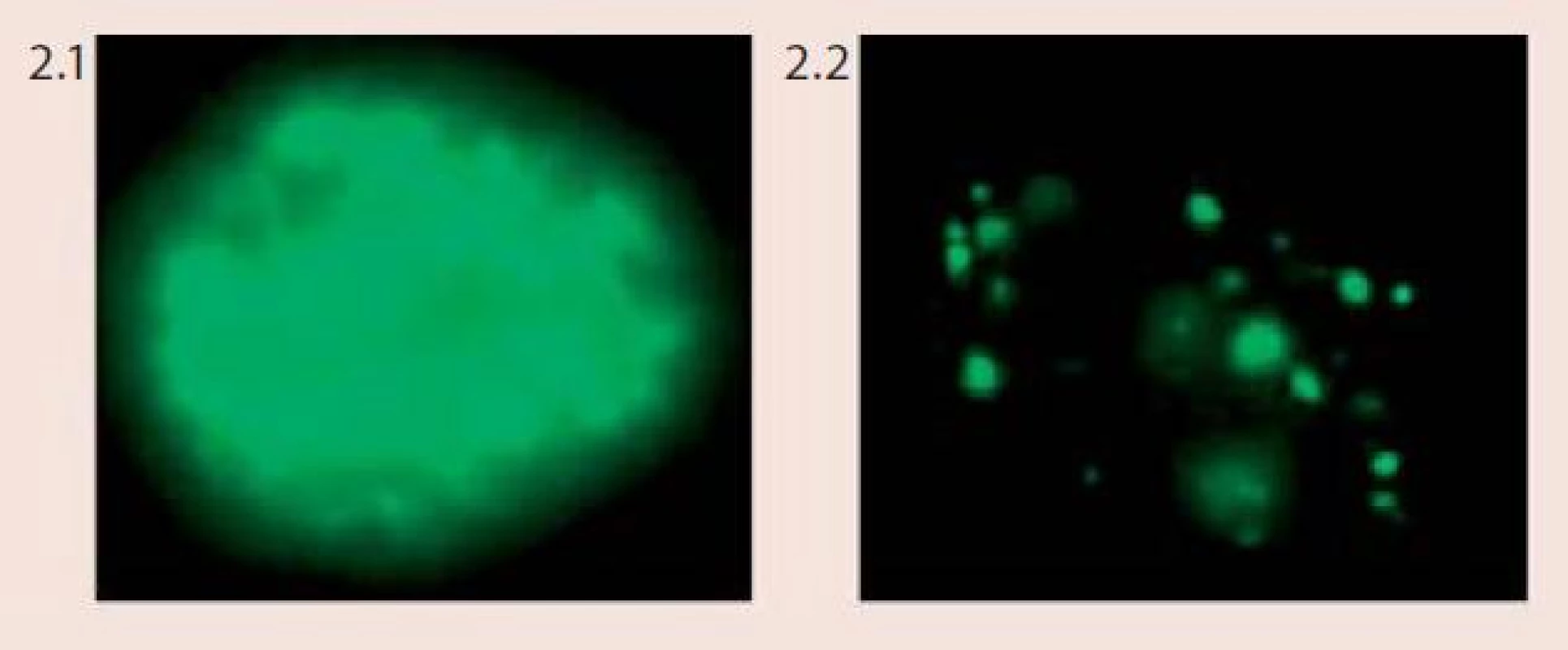 Vzor barvení buněk napadených lidským papilomavirem (HPV) při použití Vysis Cervical FISH Probe Kit (foto Laboratoř molekulární cytogenetiky ÚEB PřF Brno)
Obr. 2.1 Difuzní vzor barvení (epizomální status viru)
Obr. 2.2 Tečkovaný vzor barvení (integrovaný status viru)