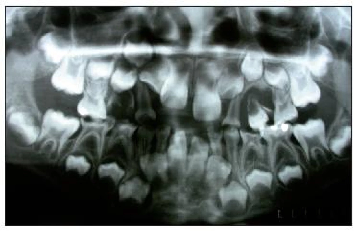 Ortopantomogram před extrakcí zubu 24.