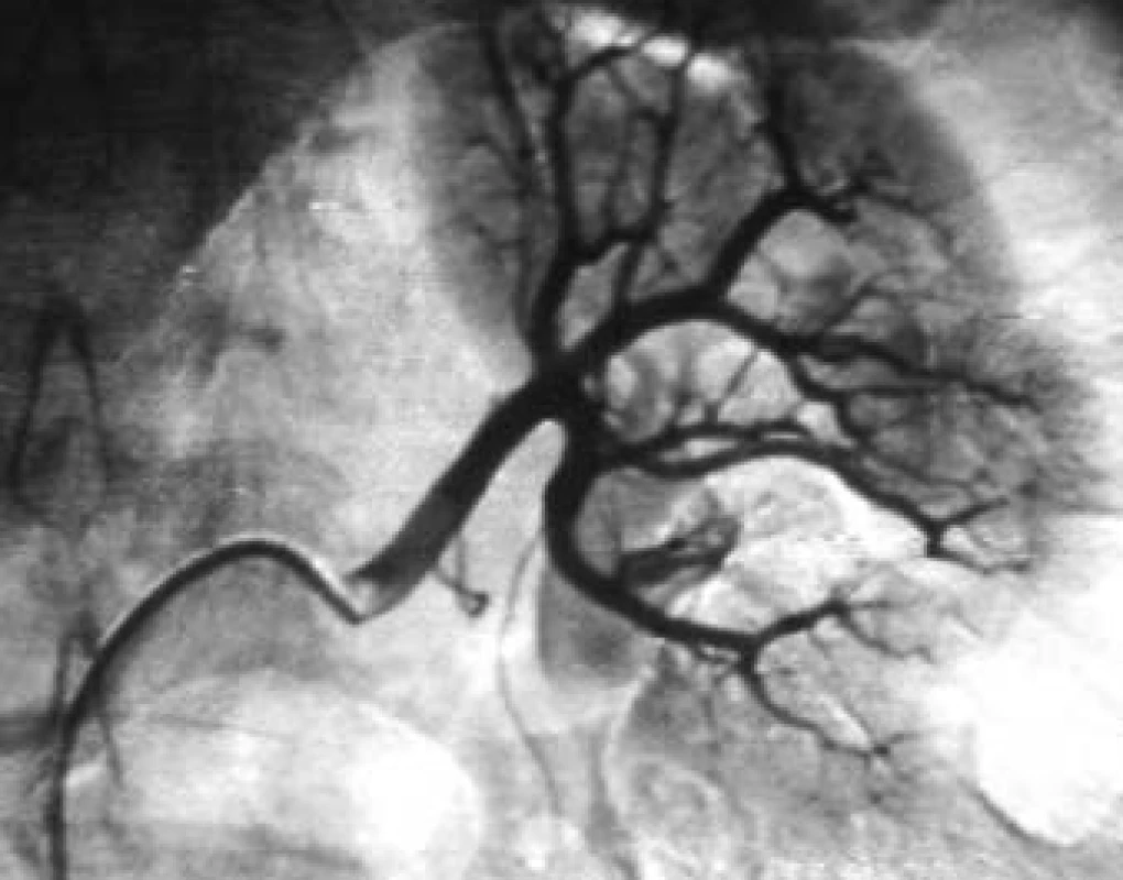 Angiografie hlavní renální tepny zásobující horní 2/3 levé ledviny.