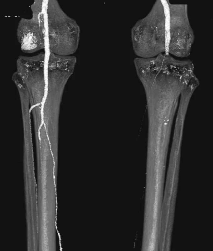 CTA obraz embolie do podkolenní tepny vpravo
Fig. 14: CTA image embolism in the right popliteal artery