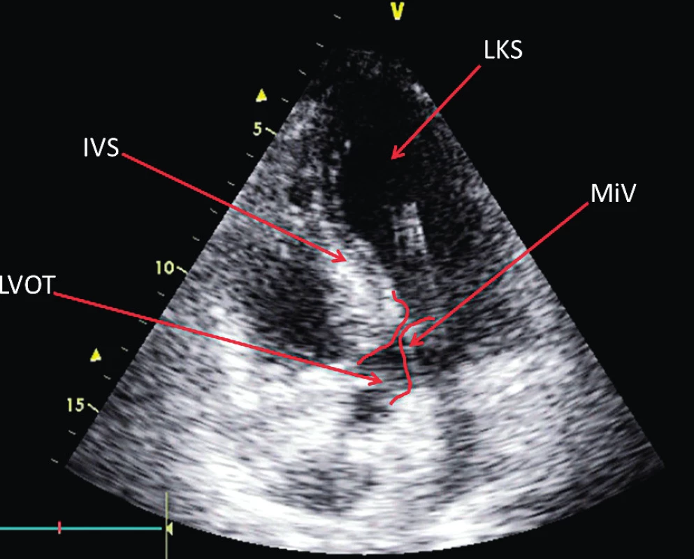 Echokardiografický nález obstrukce výtokového traktu levé komory srdeční při dopředném pohybu cípu mitrální chlopně