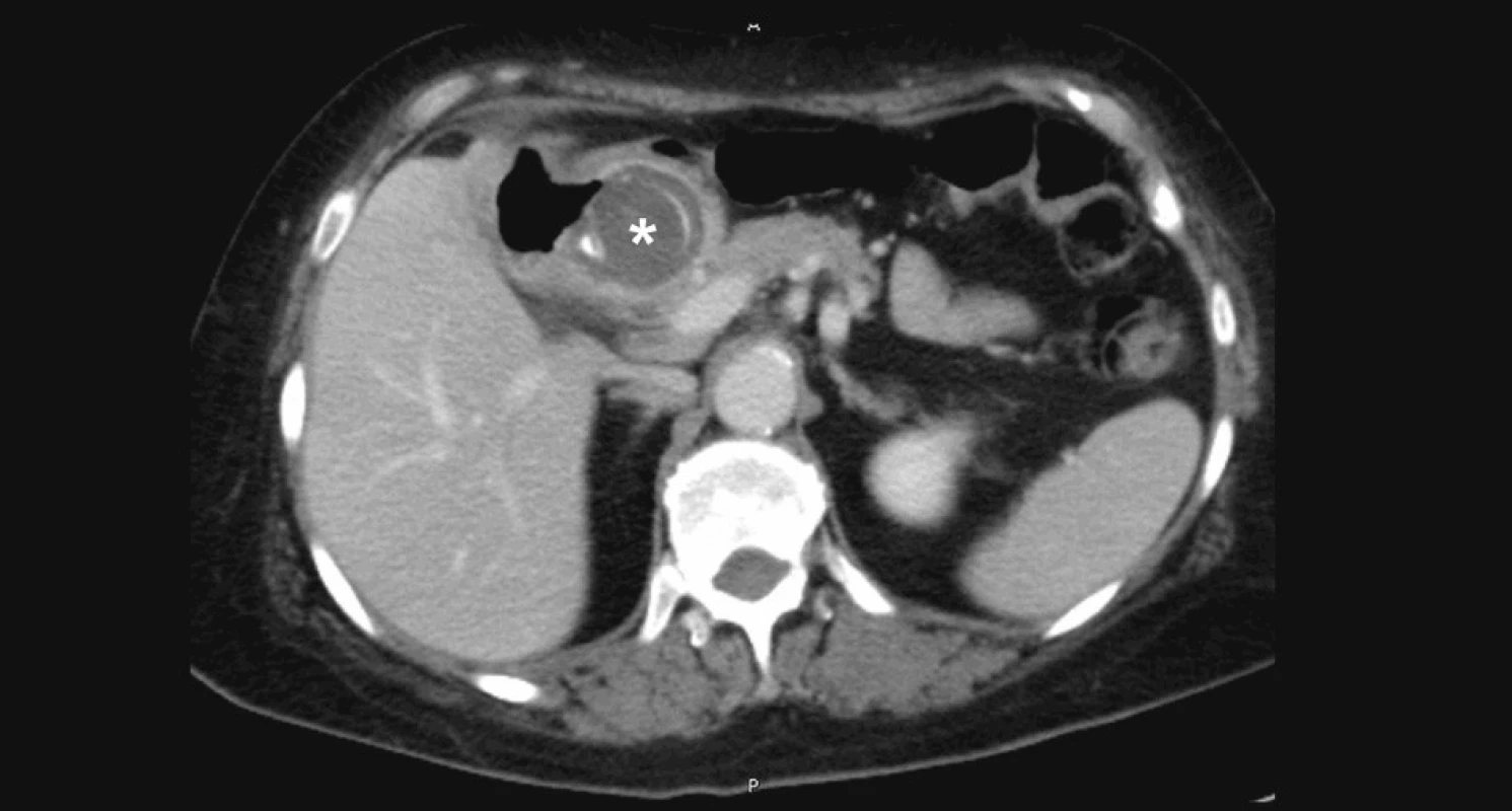 CT vyšetření v transverzální rovině: při hlavě pankreatu, mediálně od jater lze pozorovat vycestovaný žlučový konkrement (*), současně plynem naplněný původní vak žlučníku a plynem vyplněnou i samotnou širokou cholecystoduodenální píštěl
Fig. 4. CT examination in the transverse plan: near the pancreatic head, medially to the liver, an excreted bile concrement is detectable (*), while the gallbladder and the wide cholecystoduodenal fistule are filled with gas