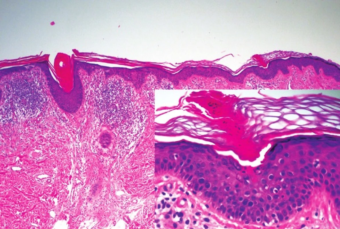 Histopatologický obraz kornoidní lamely u porokeratosis superficialis actinica z periferie léze
Detail kornoidní lamely tvořené vertikálním pruhem parakeratózy s dyskeratotickými a vakuolárně degenerovanými keratinocyty v epidermis pod ním (HE, 40 x, 200 x)