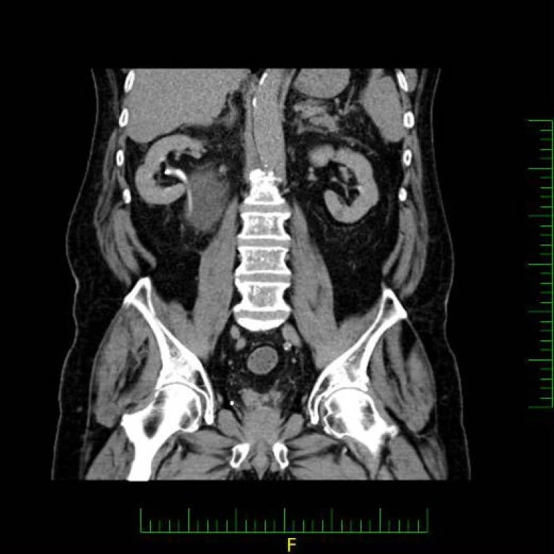 CT, koronární řez, vylučovací fáze: nedilatovaná pánvička pravé ledviny
Fig. 2. CT scan, coronal section, excretory phase: a non-dilated right renal pelvis