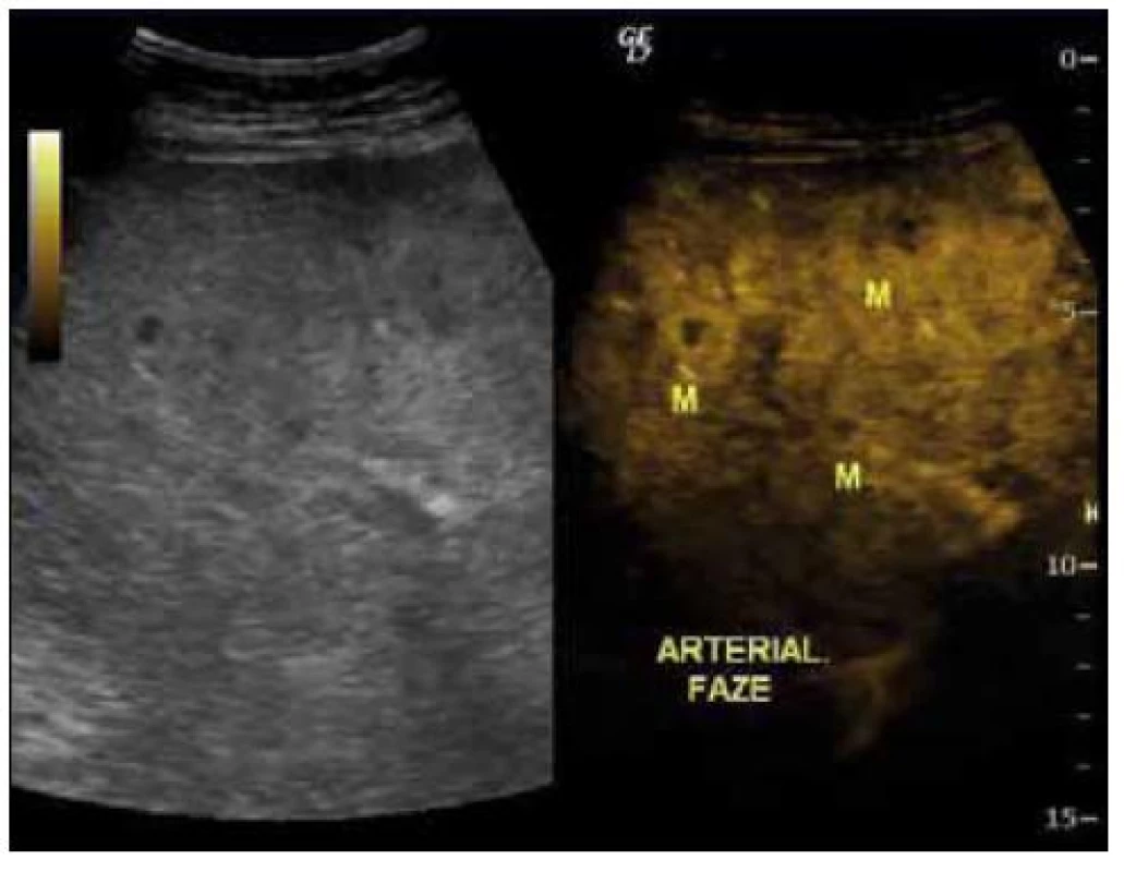UZ břicha, vpravo s podáním kontrastu v arteriální fázi se sycením ložisek označených písmenem M.