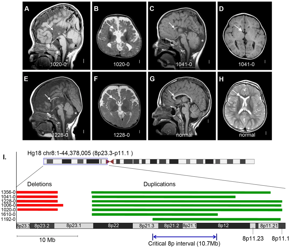 Brain magnetic resonance imaging and critical region analysis of the duplication-deletion 8p syndrome.