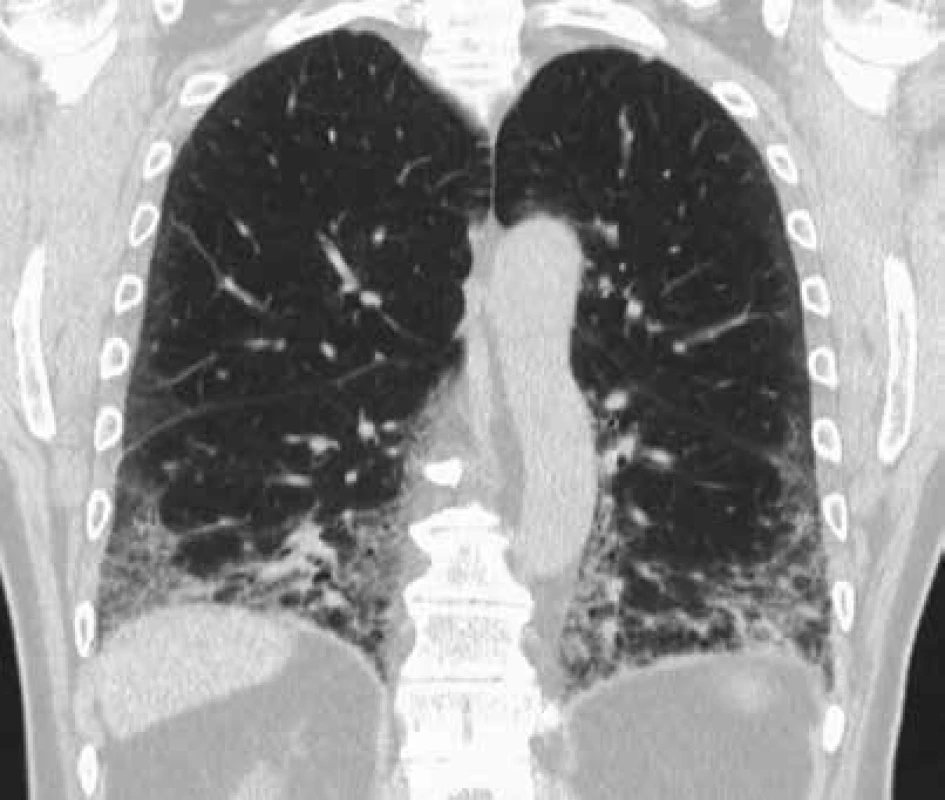 HRCT obraz charakteru obvyklé intersticiální pneumonie u pacienta s EAA