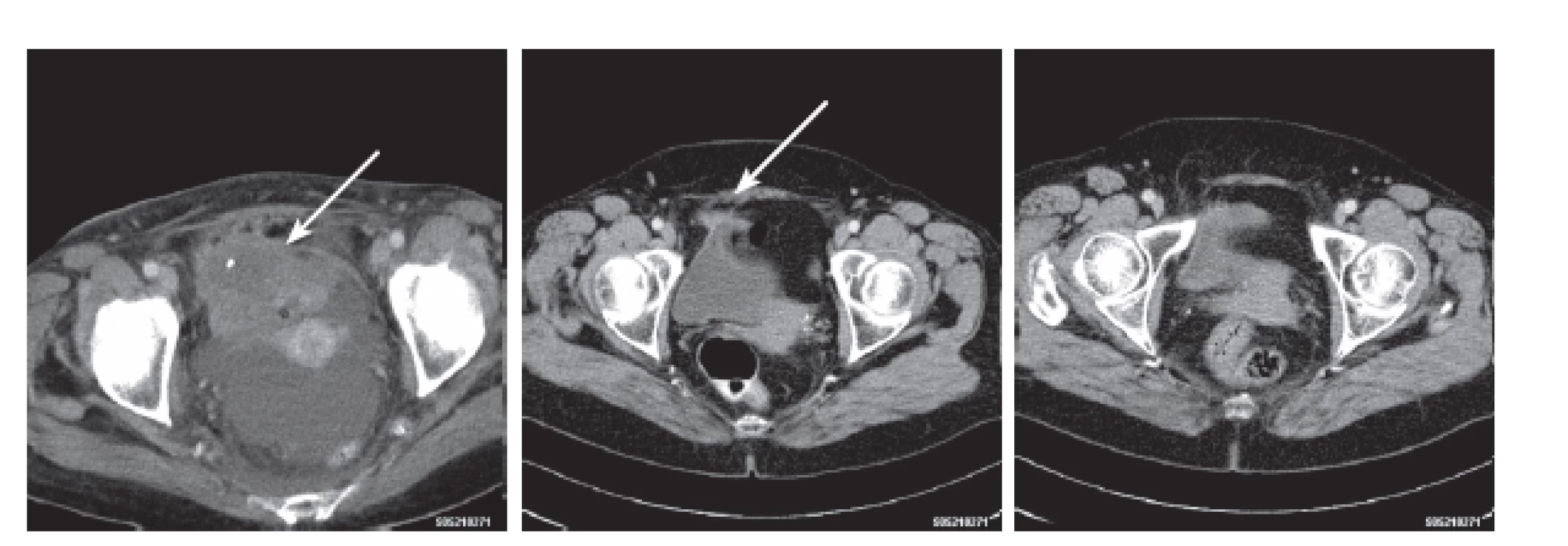 CT ložisko močového měchýře s kalcifikací – jeho regrese a vymizení
Fig. 2. Pathologic CT finding in urinary bladder – its regression and complete disappearance