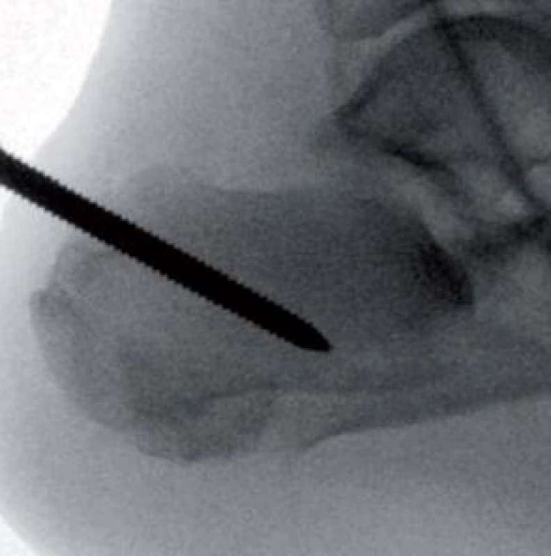 Schanzův šroub zavedený do patní kosti pro obnovu Böhlerova úhlu a správné osy patní kosti