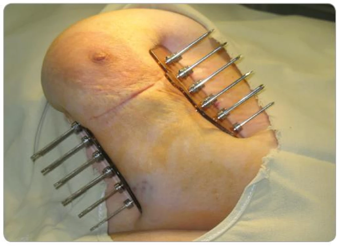 Trojrovinná intersticiálna brachyterapia pätnástimi kovovými ihlami.